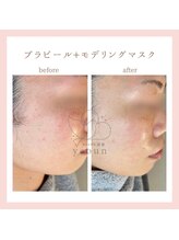 韓国肌管理yeoun【ヨウン】ROMAPINK/黒ずみ/毛穴/プラピール/ララピール福岡天神/プラピール/プラピール福岡