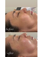 マホロバ(mahoroba)/ダーマ鍼幹細胞導入＋美容鍼