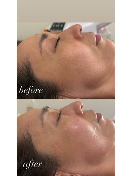 マホロバ(mahoroba)/ダーマ鍼幹細胞導入+美容鍼