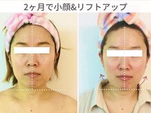 小顔コルギアンドフェイシャルサロン ジュエル(JEWEL)の雰囲気（フェイスラインを骨格から引き上げ卵型の小顔に仕上げました）