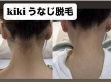 キキ(kiki)/うなじ脱毛