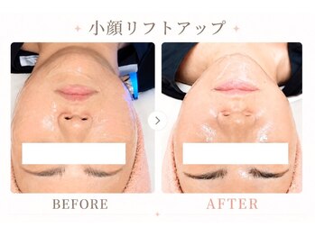 パールプラス 伊勢店(Pearl plus)/小顔リフトアップも叶う♪