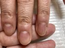 【お悩み事例】手荒れ爪の縦すじ