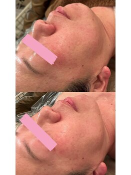 サロン ド ミニョン(salon de mignon)/シャープな顎ラインになりたい！