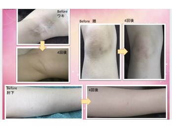 エルマナ(HERMANA)/全身脱毛/vio/毛穴/顔、フェイス