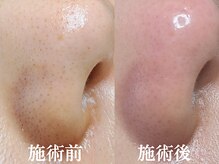 ルリノエプラスウイ(RURINOE+ui)/毛穴黒ずみ☆詰まり改善