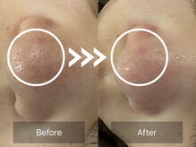 ケアナ 梅田店(CareNa)/毛穴黒ずみ特化【70分】徹底洗浄