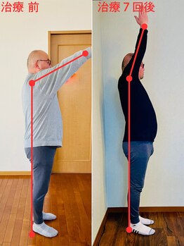 美シセイ整体 所沢店/50代。肩が挙がらない症状