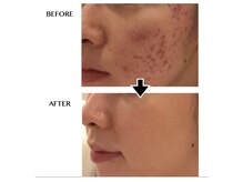 ウニ(uni)/【オーダーメイド肌管理】