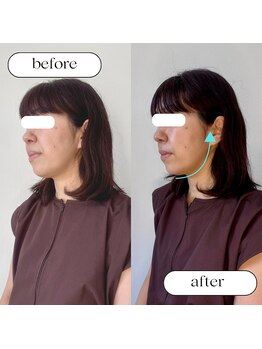キューサッポロ(SalonQSapporo)/たるみに美容鍼ビフォーアフター
