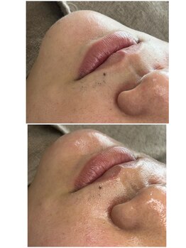 リノ(Lino)/フェイシャルワックスでつるつる