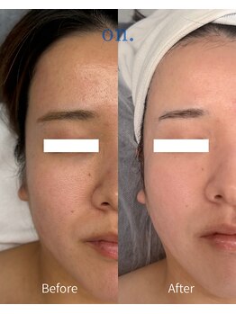 オン(on.)/《お客様症例》施術1回