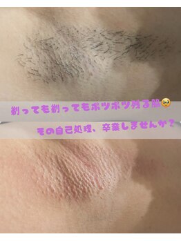 ジョエルワックス 沖縄糸満店(JOELLE WAX)/両脇ダブル脱毛