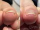 ポドロ(PoDoLo)の写真/目立たない仕上がりでマニキュアも楽しめる巻き爪補正。爪の健康を守りながら美しく整えます