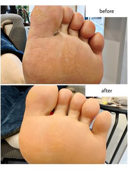 ケアプラス(care plus)/足裏角質ケア