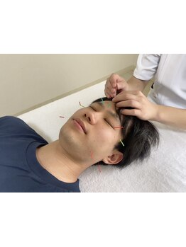 鍼灸施術を受けたい