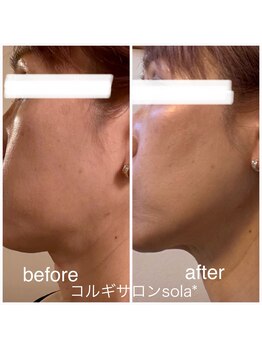 ソラ(sola*)/脂肪分解『レモンボトル』