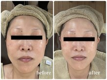 ジャスミン(Jasmin)/マイクロキャビ×RF×脂肪分解