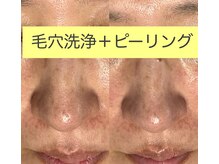 レアマカナ(LeaMakana)/毛穴洗浄＋ピーリング