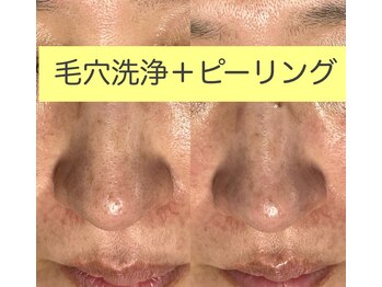 レアマカナ(LeaMakana)/毛穴洗浄+ピーリング