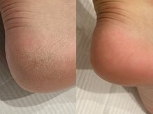 ネイルモア 藤が丘店(nail mor.)/フット角質ケア