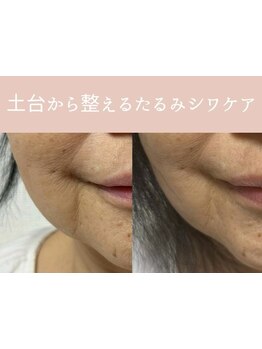 ホウレイ線・たるみ改善！予防ケア