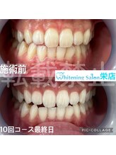 ホワイトニングサロン 名古屋 栄店&nbsp;10回コース 