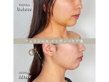 術後の女神 大阪本町店/ダウンタイムケア・インディバ