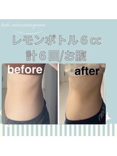 ハロ 南青山(HALO)/レモンボトル月2回×3ヶ月経過