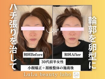 ルルラボ(LuLu beauty labo)/ハチ張り改善で卵顔