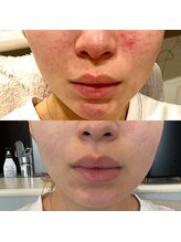 シファ(SHIFA)/肌質改善