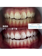 ホワイトニングサロン 熊本店/セルフホワイトニング