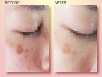 ジュリア オージェ 京橋店/ビフォーアフター(シミケアP)