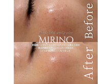 ミリノ(Mirino)/大人のエイジングケアメニュー