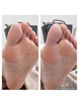 遊歩堂/ヒールダコに魚の目