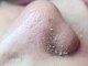 アナシアビューティーサロン(Anacia)の写真/リピートNo.1☆毛穴ケアに特化☆毛穴洗浄/毛穴エクストラクションで頑固な黒ずみ&角栓を徹底除去!初回¥7900