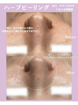 ソユ(SOYOU)/施術* &nbsp;&nbsp;&nbsp;&nbsp;ハーブピーリング