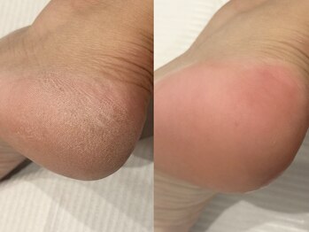 ネイルモア 藤が丘店(nail mor.)/フット角質ケア