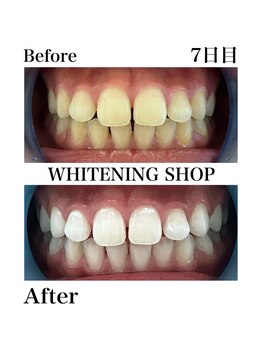 ホワイトニングショップ 刈谷店/Before&After 7日目のお客様