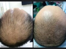 キュライム 熊本(CURAIM)/育毛促進【50代男性】