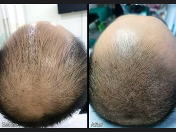 キュライム 熊本(CURAIM)/育毛促進【50代男性】