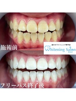ホワイトニングサロン 熊本店/熊本ホワイトニング