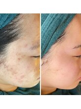 ココオーブ(COCO AUBE)/エステをうまく活用