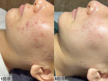 アンドミー 福岡博多店(&me)/ハーブピーリング【ニキビケア】