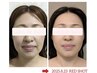 モニター募集！《☆韓国最新レッドショット》小顔たるみ改善！ ¥13200→¥8800
