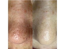 シール(Syl)/プロセルセラピーズ症例