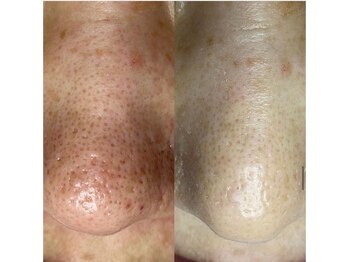 シール(Syl)/プロセルセラピーズ症例