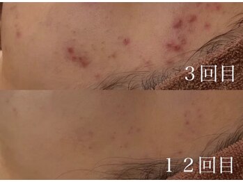 アワピール 天王寺店(AWA PEELL)/ハーブピーリング/毛穴/天王寺