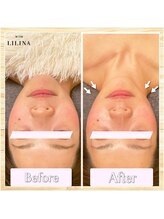 ウィズリリナ 新横浜(with Lilina.)/◆話題の最新小顔/痩身マシン♪