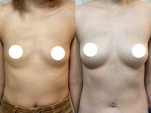 ハレオラ(HaleOla)/お客様の変化☆バストケア30代